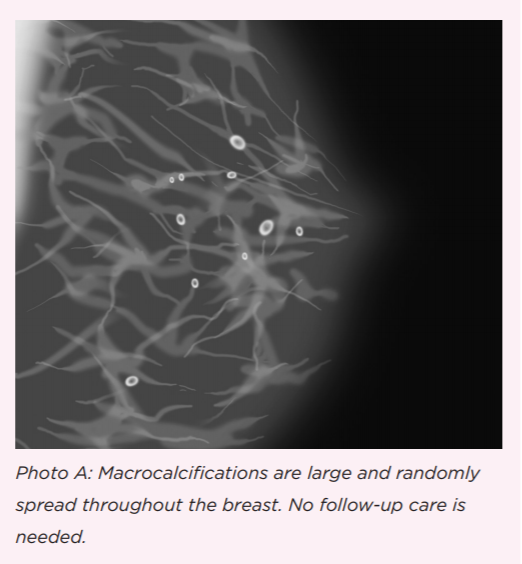 breast calcification clusters