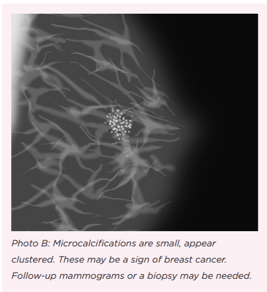 What Do You Mean, I Have 'Calcifications' in My Breast?: Understanding Why  Calcium Deposits Can Show Up on A Mammogram - SurvivorNet