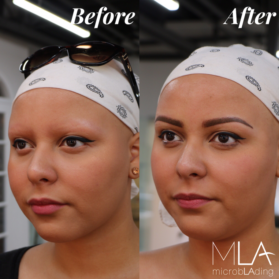 Eyebrow Loss While Fighting Cancer Can Be Devastating, But