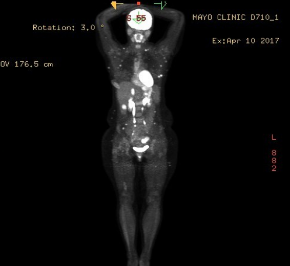 Stage IV cancer scan