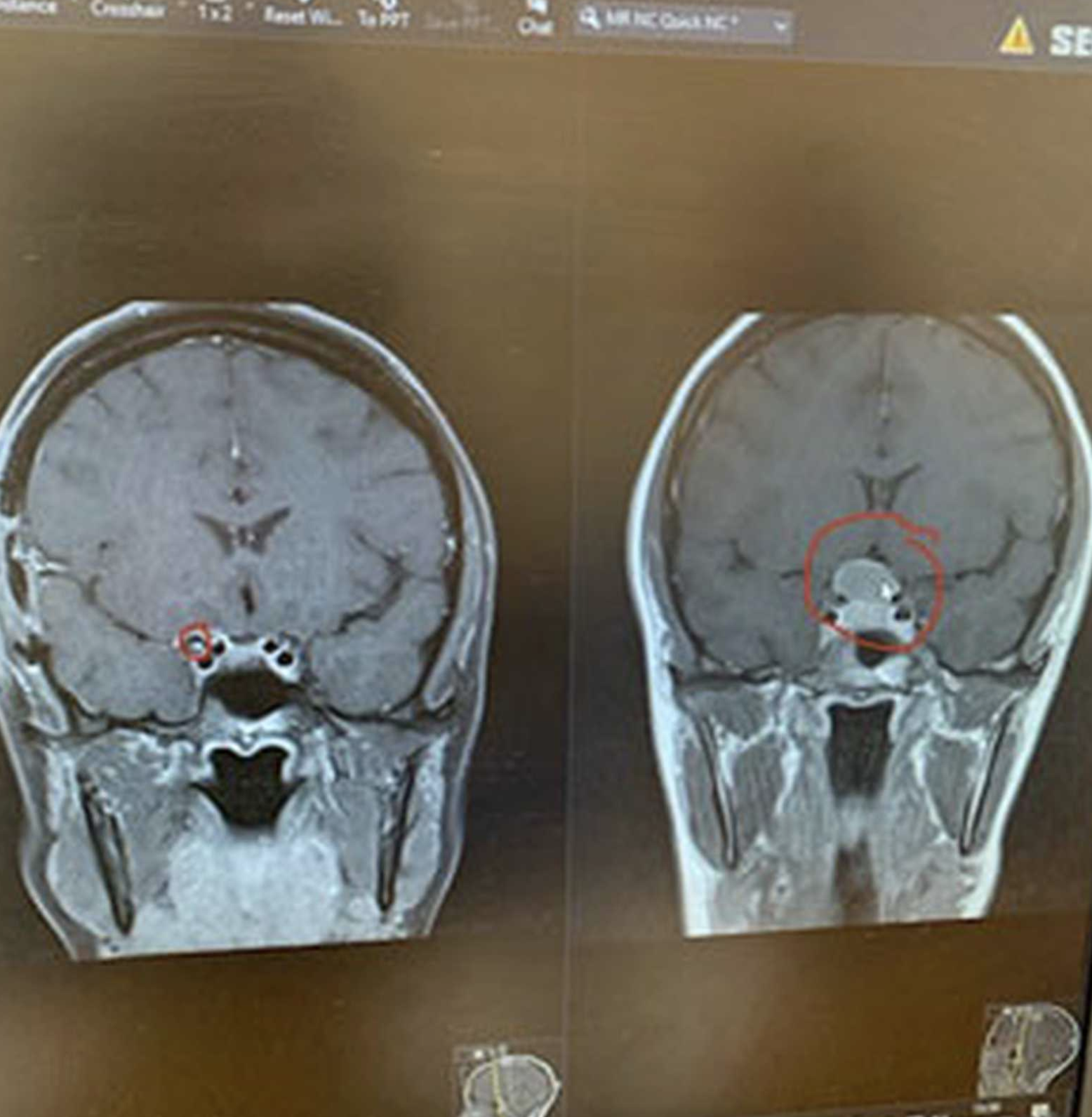 Tammy Andrews Brain Tumor