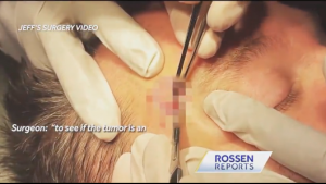 Rossen spent two hours in surgery (above) while his cancer was removed during Mohs surgery