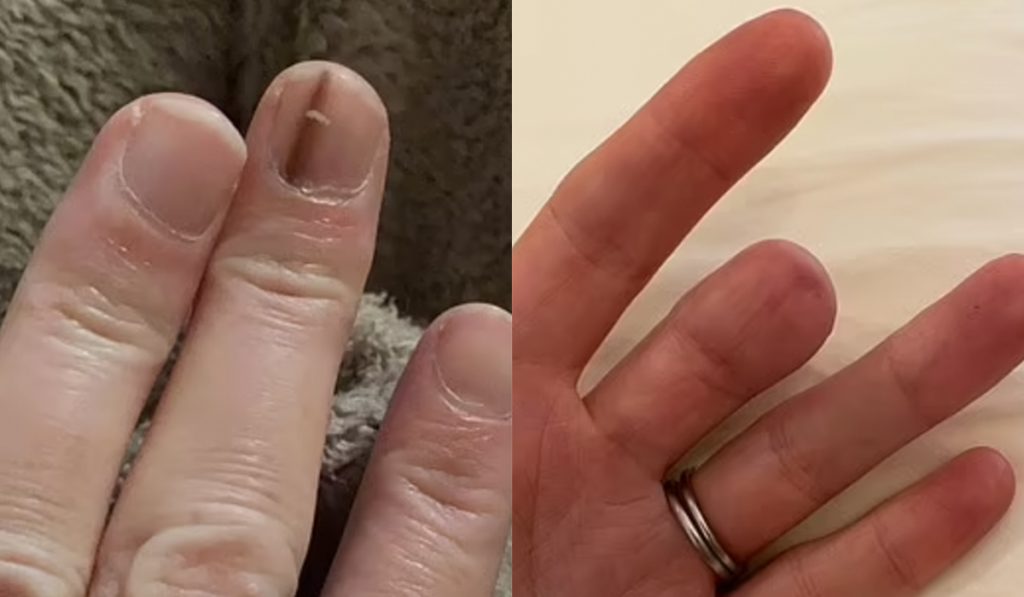Black line on finger nail - Melanoma? Skin cancer? - Page: 4