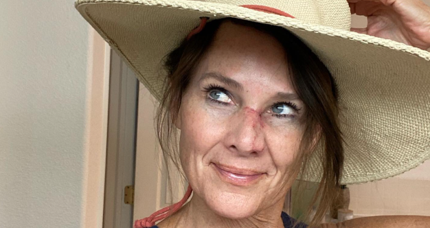 Meteorologist Kathy Sabine Shows Off Her Healing Face After Skin Cancer
