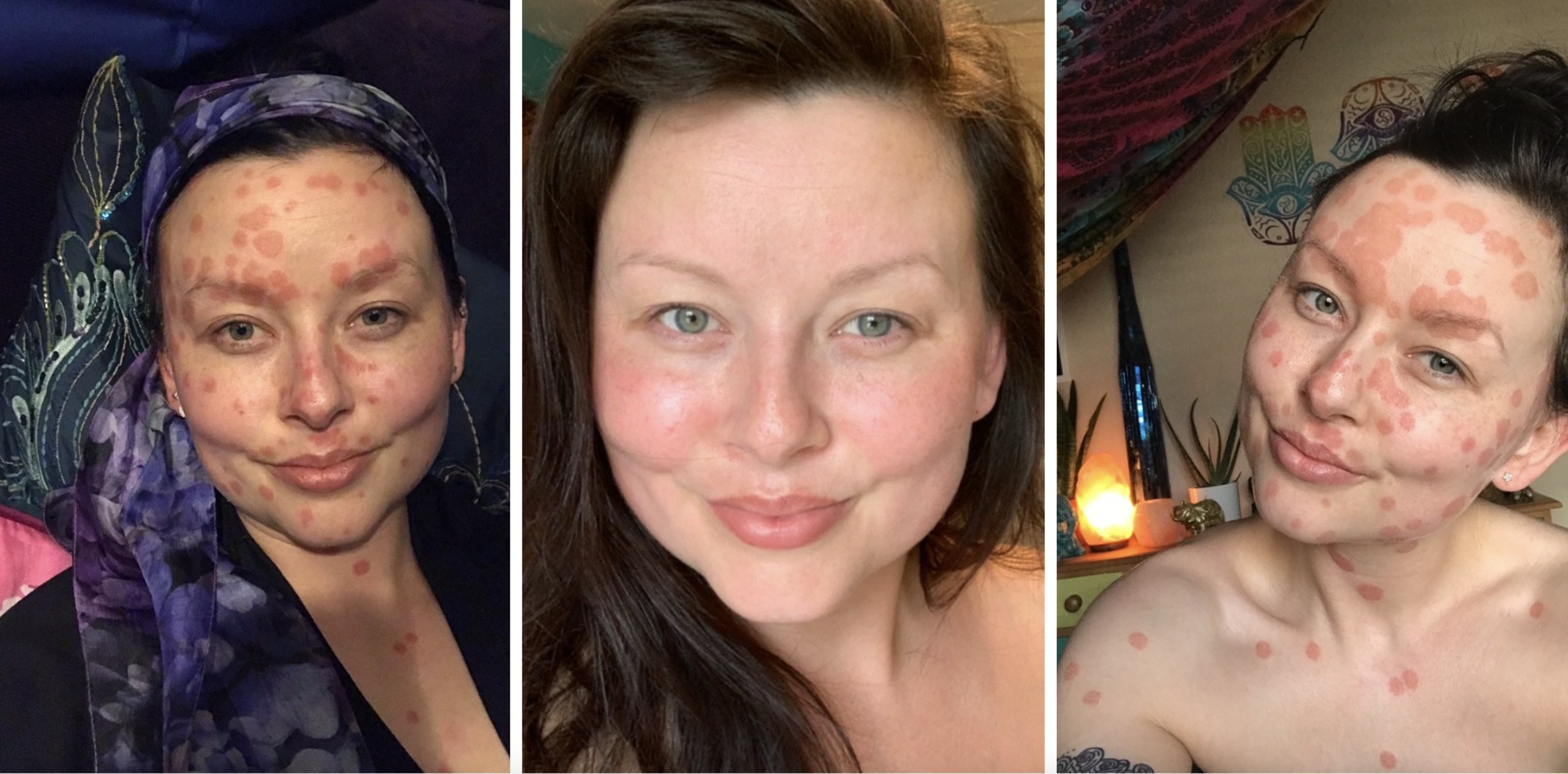 GetYourSkinOut on X: THAT #psoriasis itch under your boobs